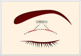 部分切開法