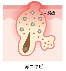 赤ニキビ