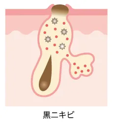 黒ニキビ
