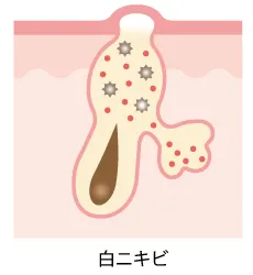 白ニキビ
