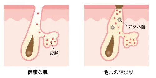 健康な肌、毛穴の詰まり
